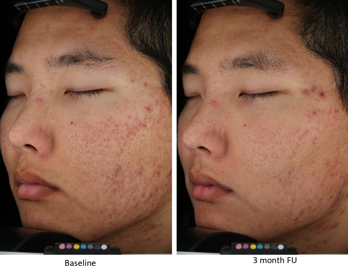 Scar Removal By Dermatologist at Albert Jenkins blog