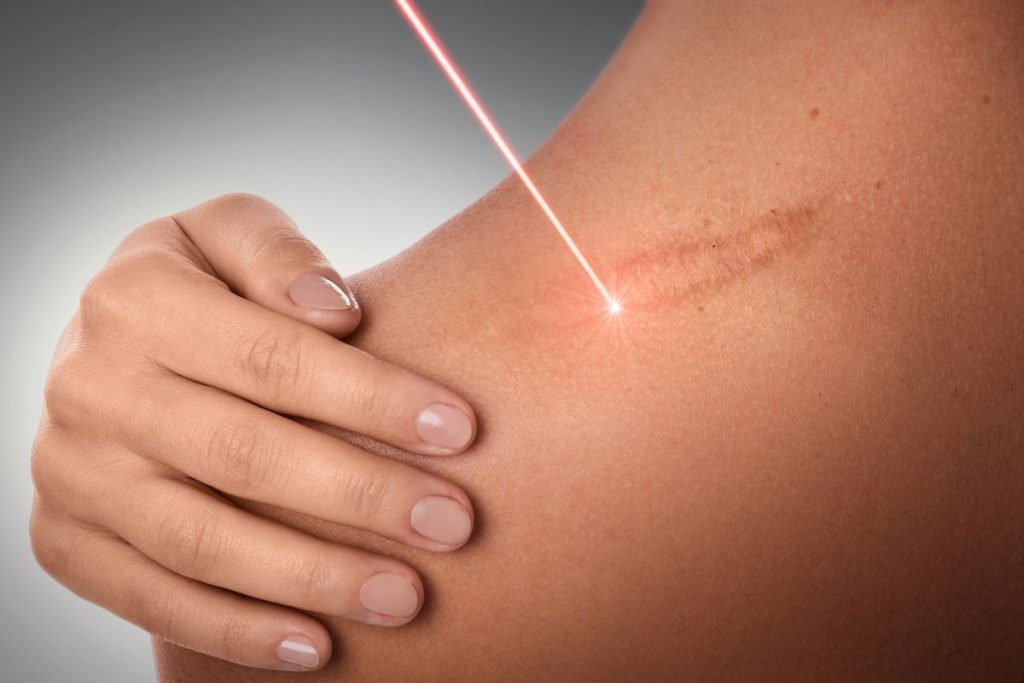 Laser scar removal in Sacramento