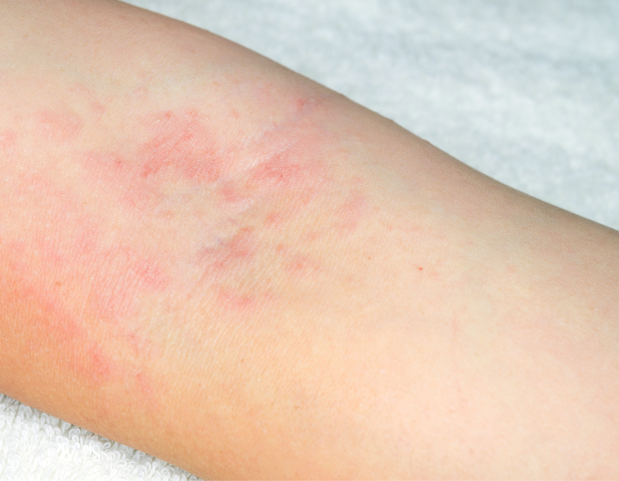 Rashes and Their Causes - Sacramento, CA