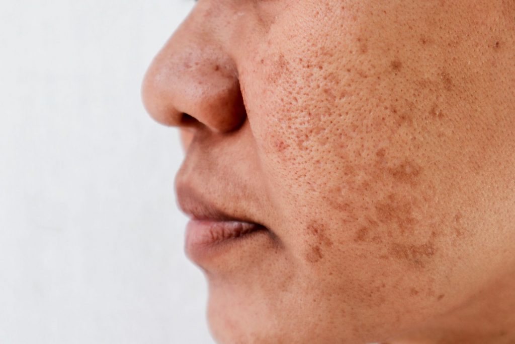 Sun damage on a woman's cheek