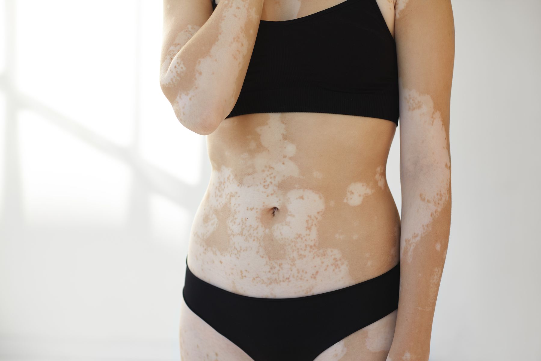 Vitiligo on a woman's body