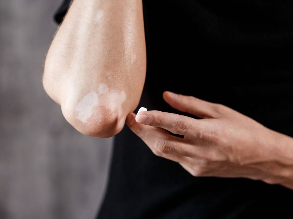 Close-up shot of vitiligo on a man's elbow