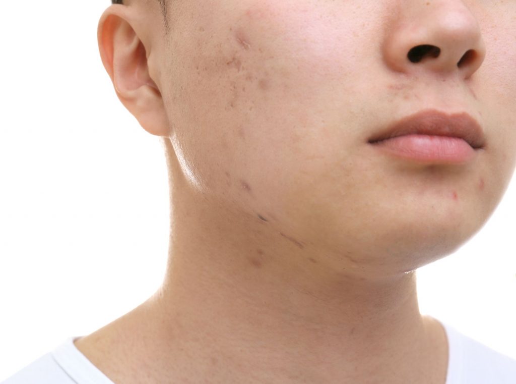 Man's face with acne and acne scars