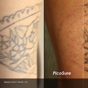 Before and after laser tattoo removal photos
