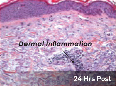 24 hours post treatment