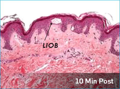 10 min post treatment