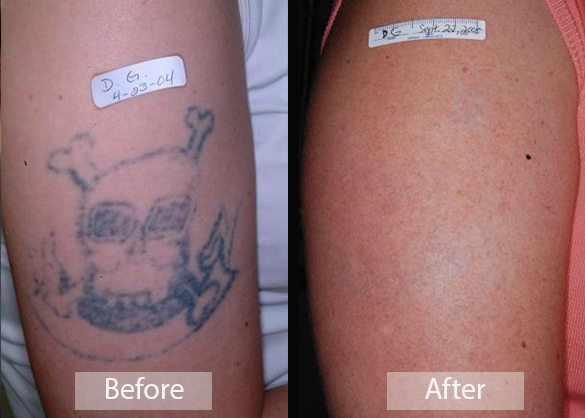 Laser Tattoo Removal Treatments  Sacramento CA