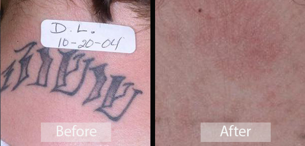 Tattoo Removal In Sacramento CA  Zen Dermatology