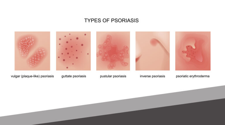 August is National Psoriasis Awareness Month - Emil A. Tanghetti, MD