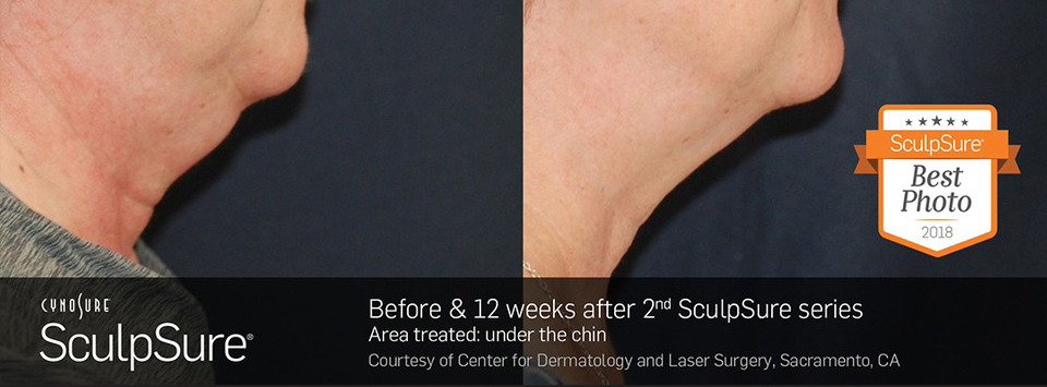 Before and after SculpSure submental results