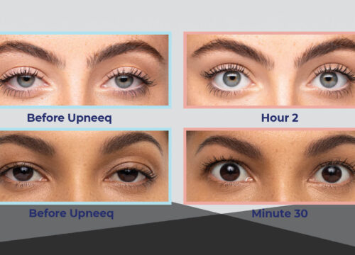 Resolve Low-Lying Eyelids