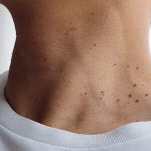 Skin Tags: What Are They & Can They Be Removed?