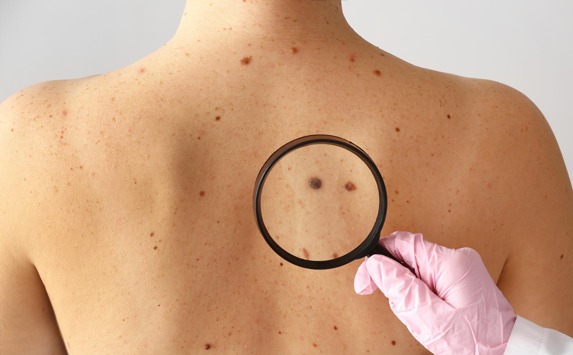 Skin Cancer Prevention & Treatment