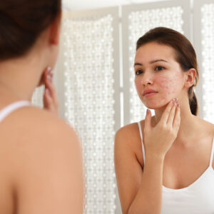 Breakouts And Red Skin? Could Be Rosacea
