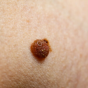 11 Signs It’s Time to Get Your Moles Checked Out by Your Dermatologist