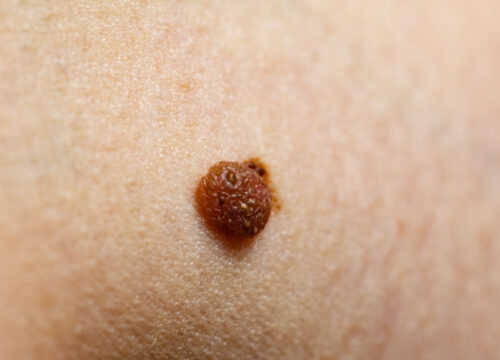 11 Signs It’s Time to Get Your Moles Checked Out by Your Dermatologist