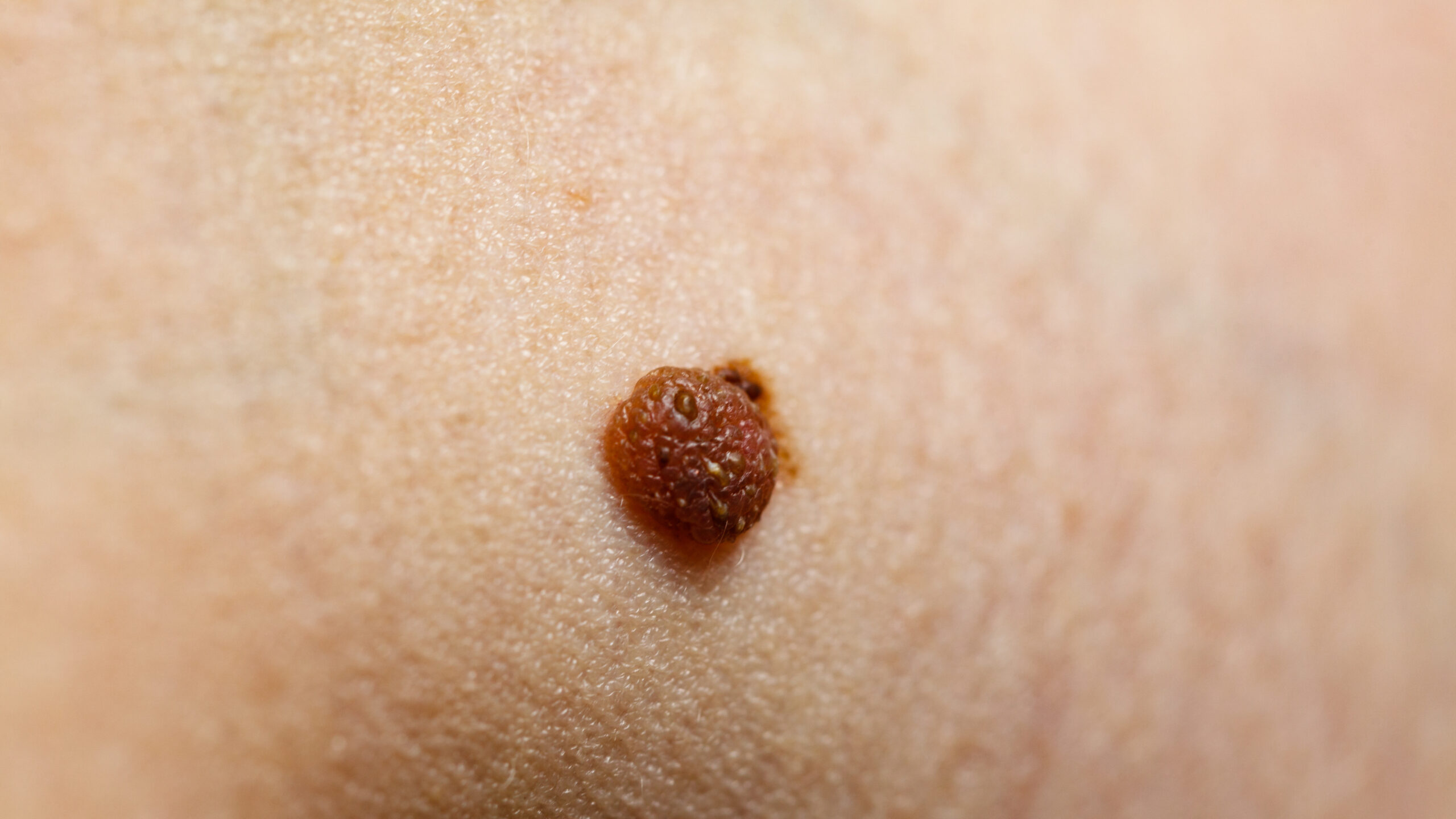 11 Signs It’s Time to Get Your Moles Checked Out by Your Dermatologist