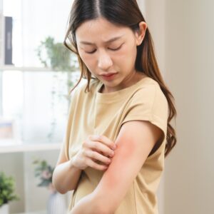 Is Eczema Contagious? Real Facts and Remedies for This Common Condition