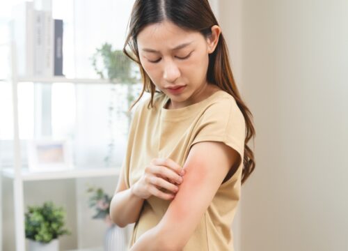 Is Eczema Contagious? Real Facts and Remedies for This Common Condition