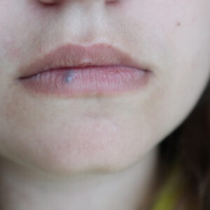 Lip Hemangioma and Venous Lakes: What Are They and What Are Your Options?