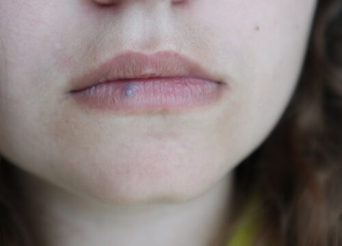 Lip Hemangioma and Venous Lakes: What Are They and What Are Your Options?