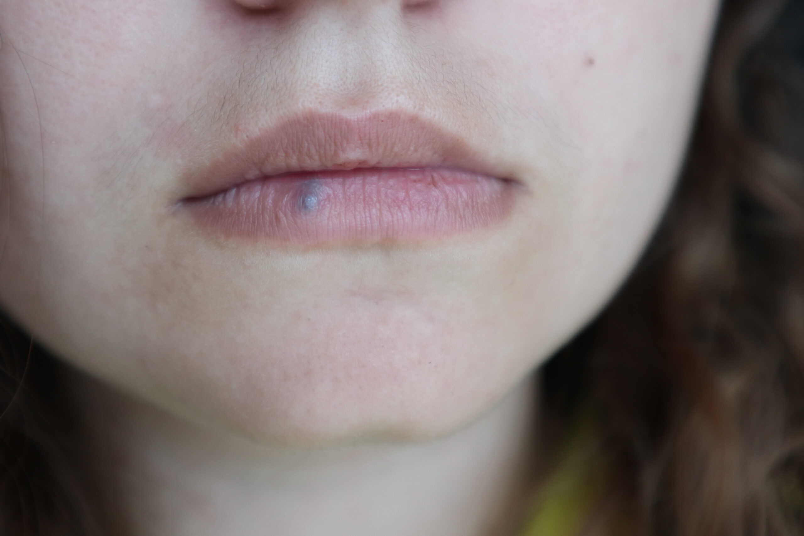 Lip Hemangioma and Venous Lakes: What Are They and What Are Your Options?