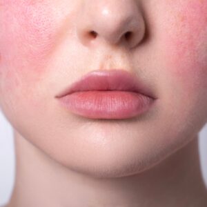 6 Tips for Managing and Living with Rosacea