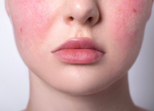 6 Tips for Managing and Living with Rosacea