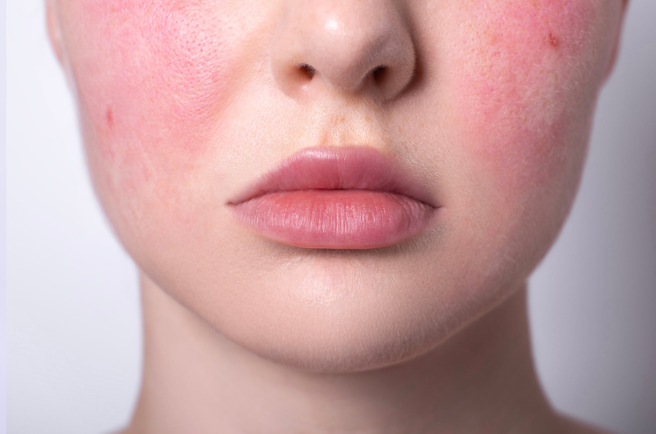 6 Tips for Managing and Living with Rosacea