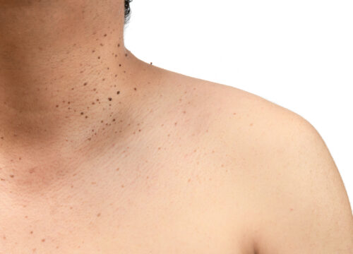 What Are Seborrheic Keratoses and How Are They Treated?