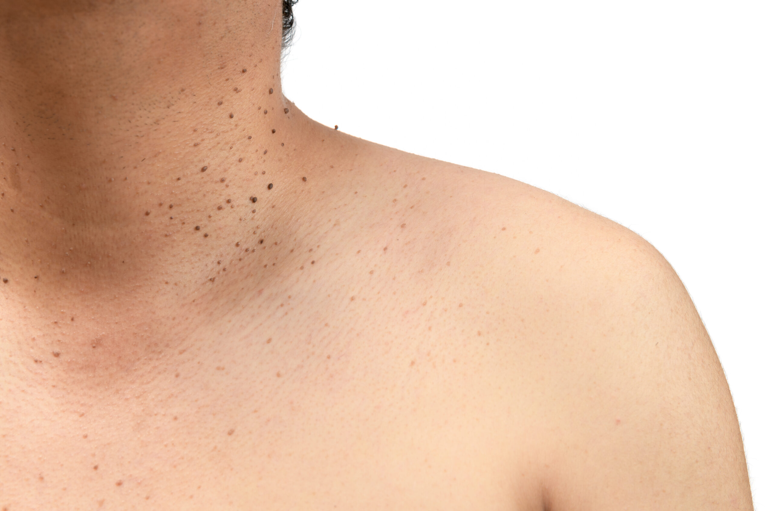 What Are Seborrheic Keratoses and How Are They Treated?