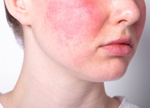 Rosacea