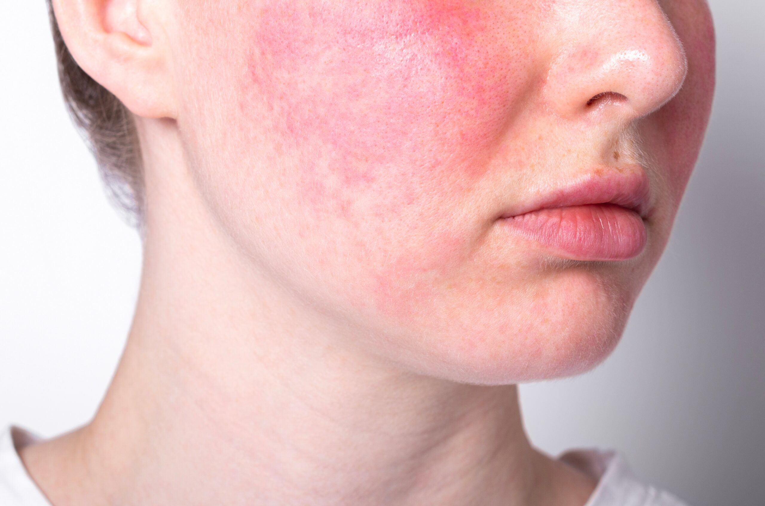 10 Hidden Triggers of Rosacea Flare-Ups You Need to Know