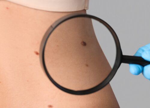 Critical Signs of Skin Cancer You Shouldn’t Ignore