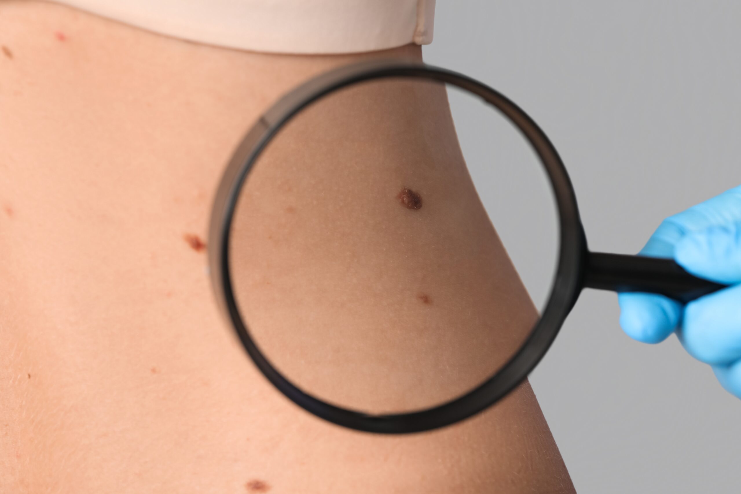 Critical Signs of Skin Cancer You Shouldn’t Ignore