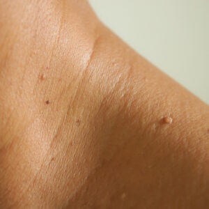 What Happens During Skin Tag Removal?