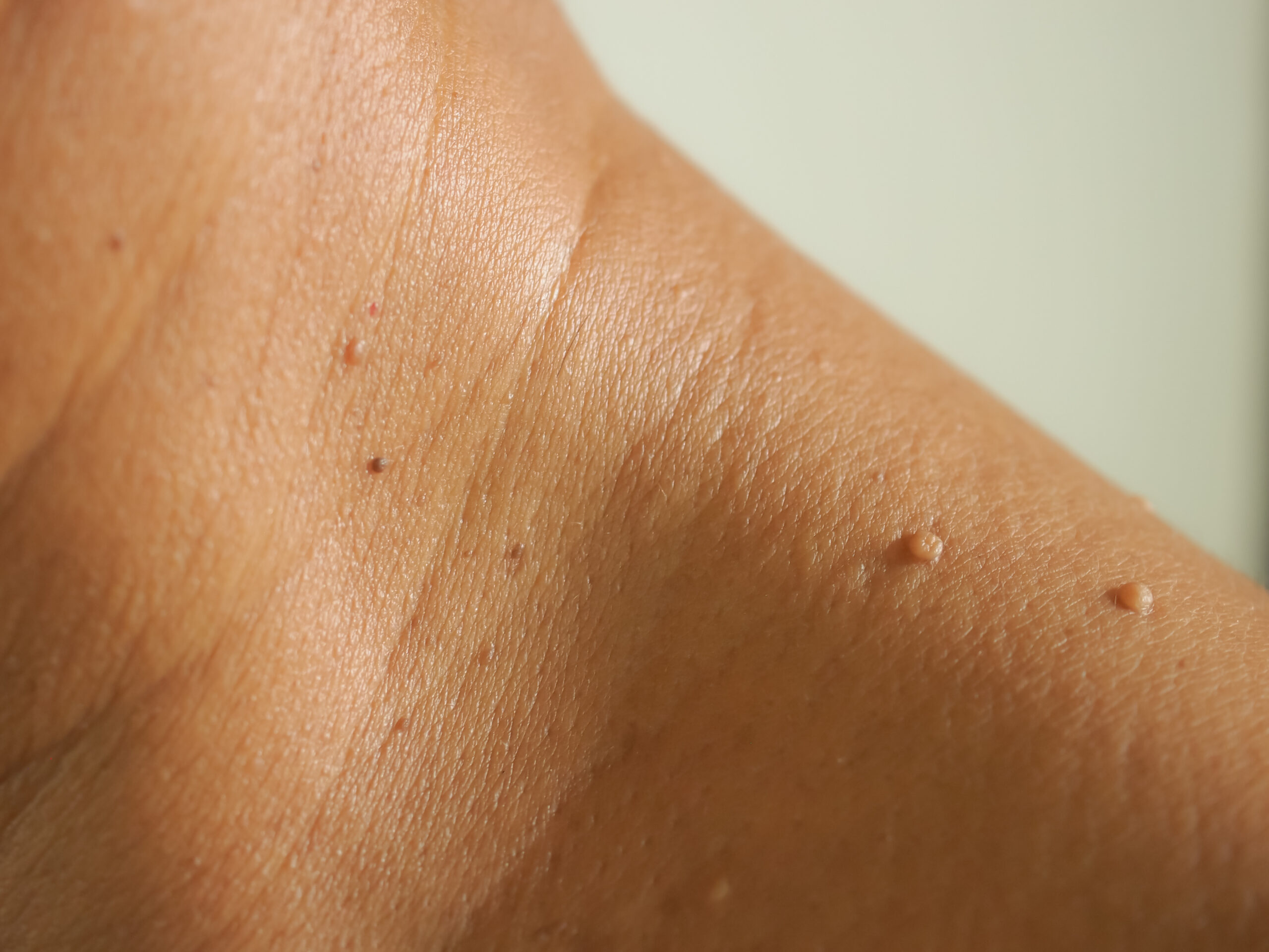 What Happens During Skin Tag Removal?