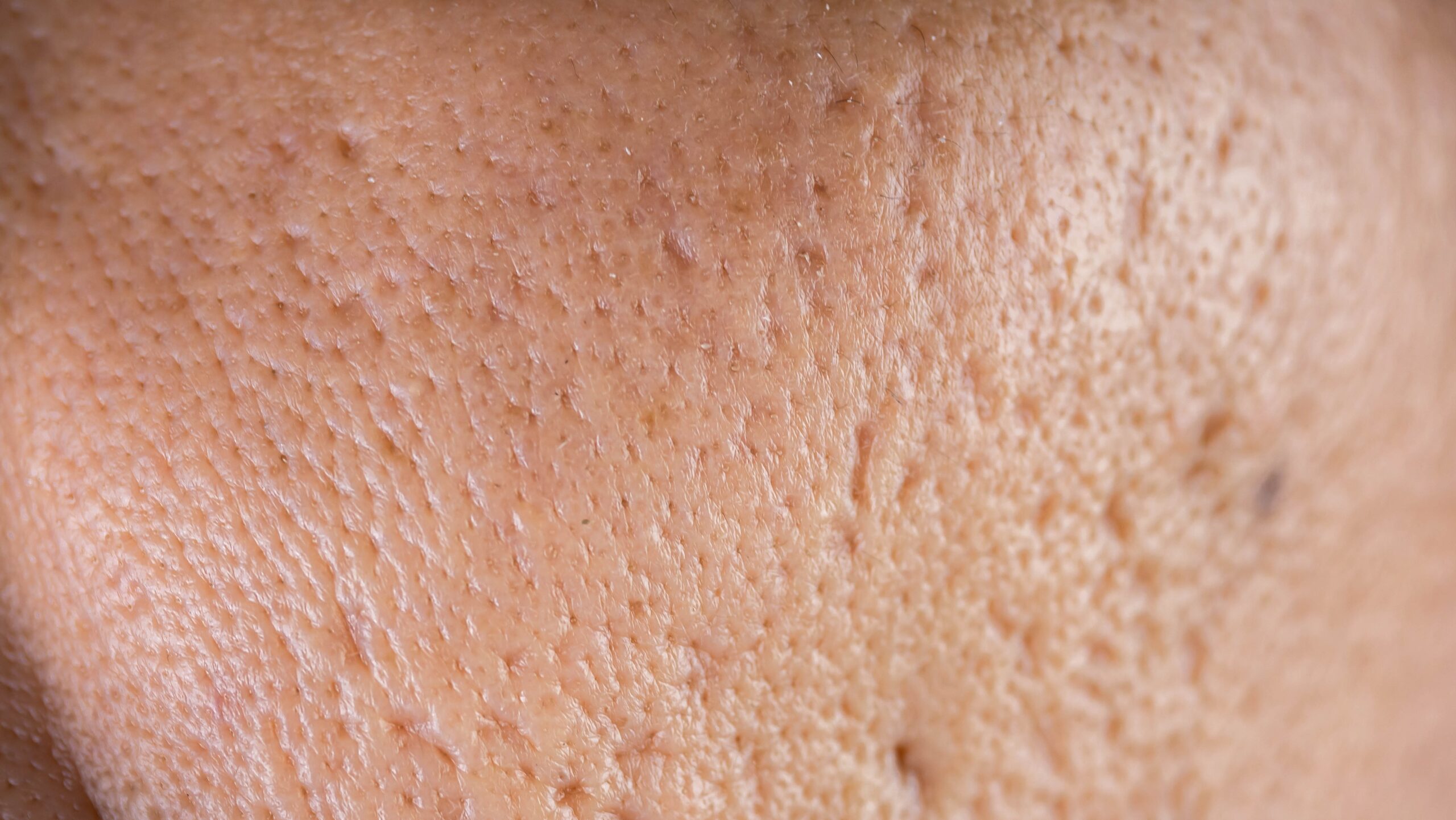 What Is the Best Treatment for Acne Scars?