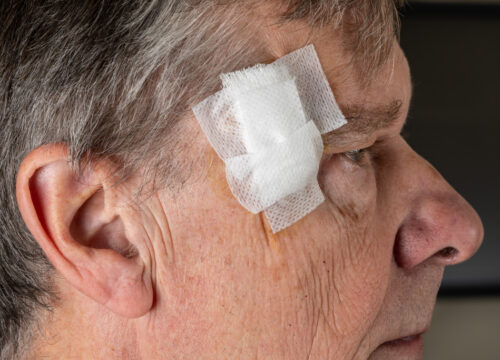 How Mohs Surgery Works to Effectively Treat Skin Cancer