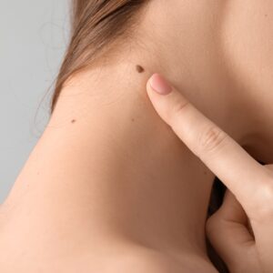 What are the Key Differences Between Normal Moles and Atypical Nevi?