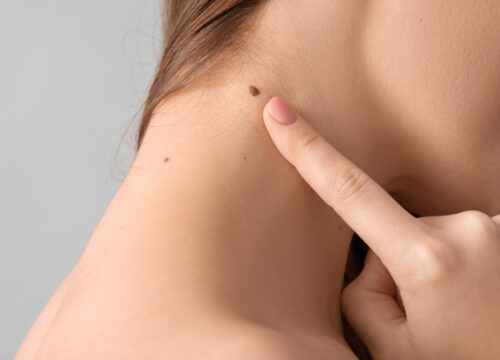What are the Key Differences Between Normal Moles and Atypical Nevi?