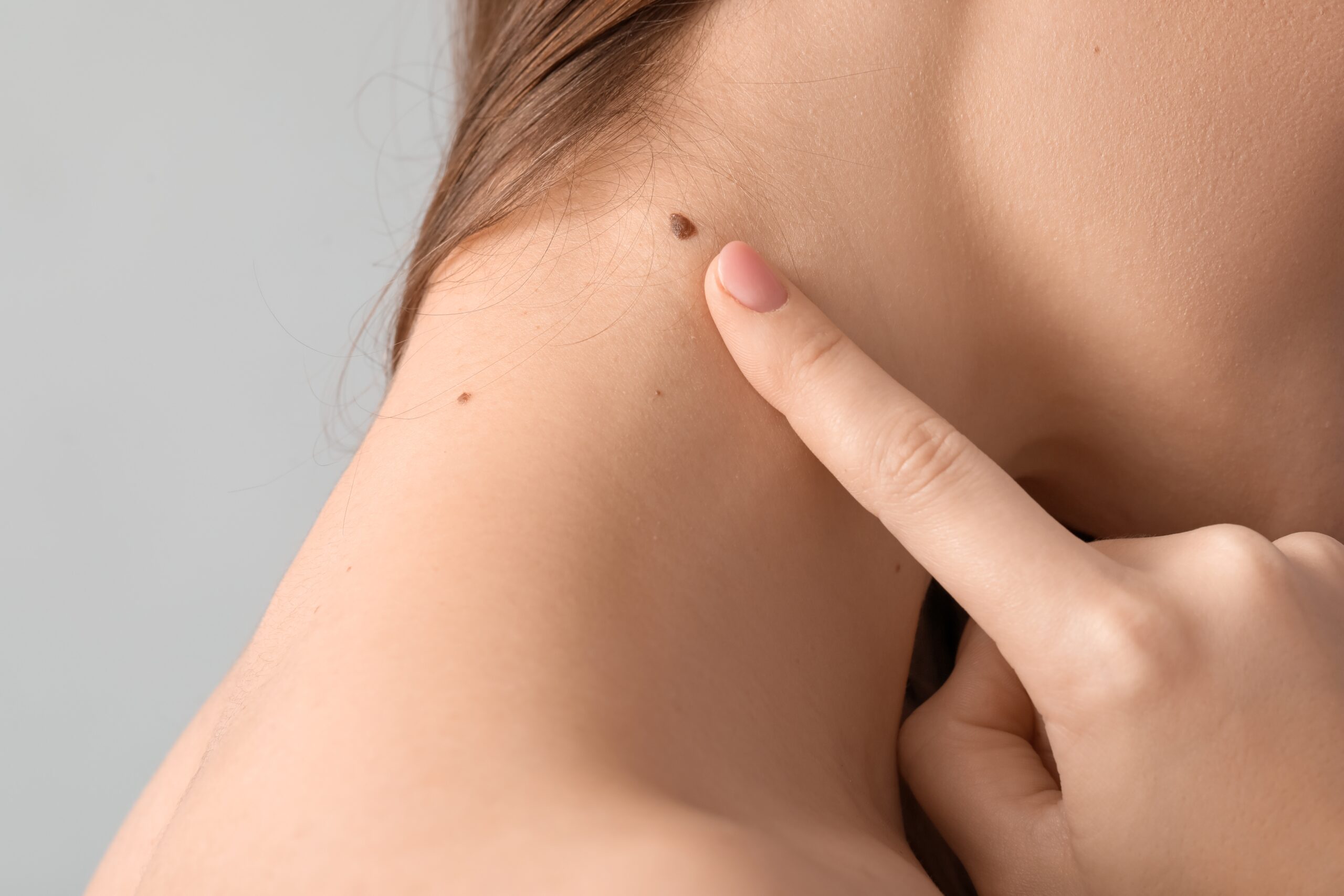 What are the Key Differences Between Normal Moles and Atypical Nevi?