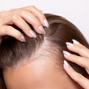 8 Signs You Should See a Dermatologist About Hair Loss