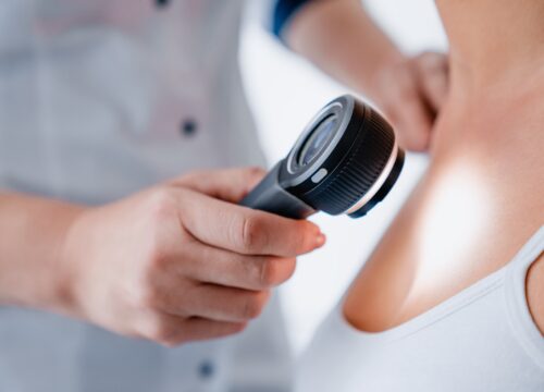 Most Common Questions About Basal Cell Carcinoma
