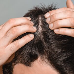 Choosing Between Surgical and Non-Surgical Hair Restoration