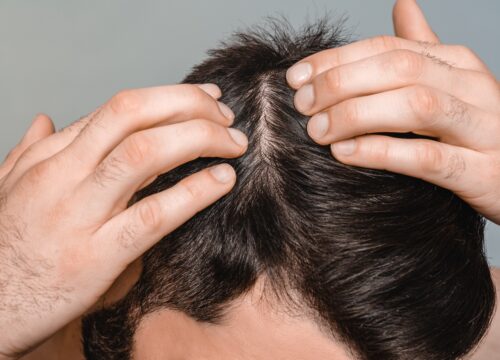 Choosing Between Surgical and Non-Surgical Hair Restoration