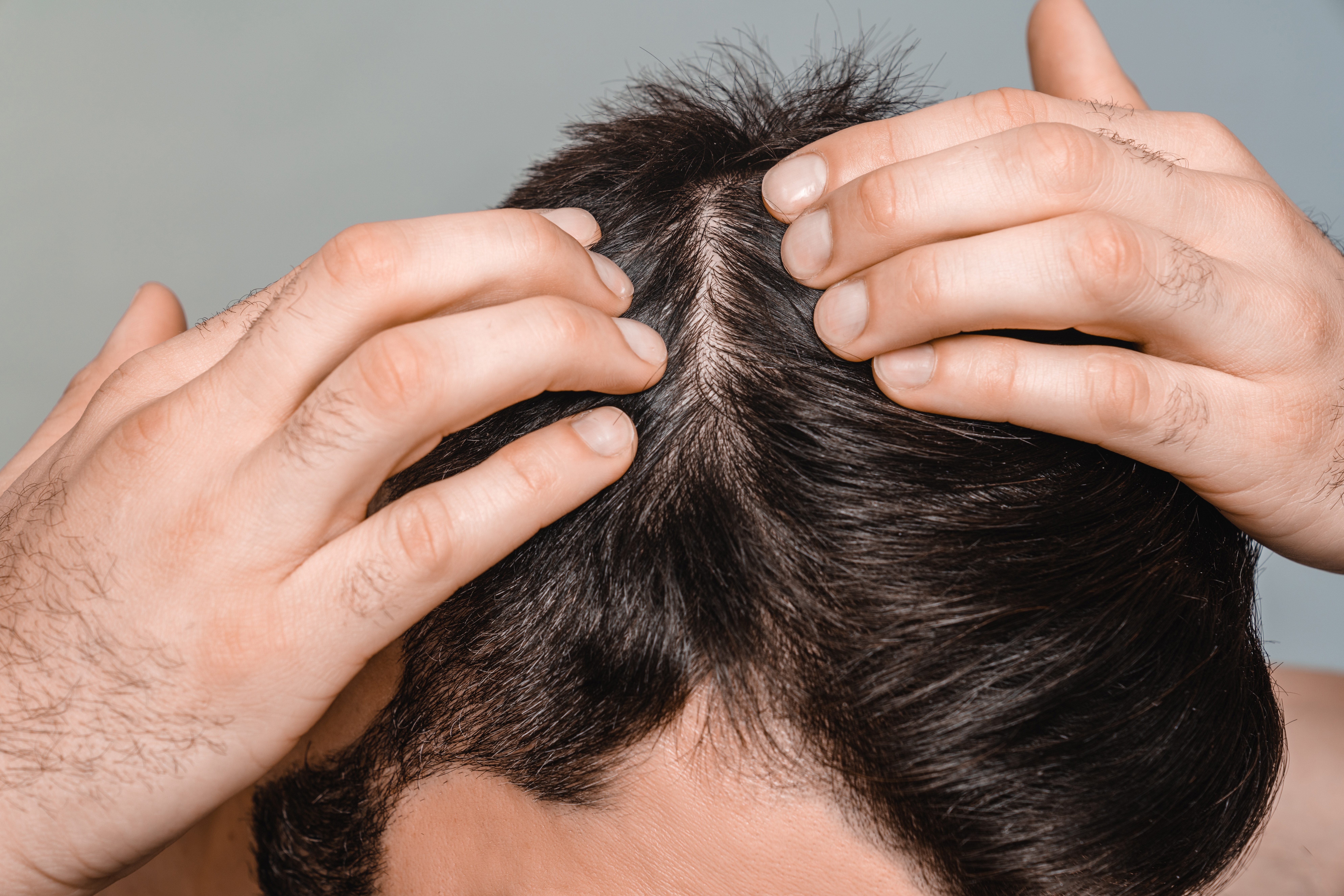 Choosing Between Surgical and Non-Surgical Hair Restoration
