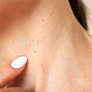 When Should You Worry About a Skin Growth?