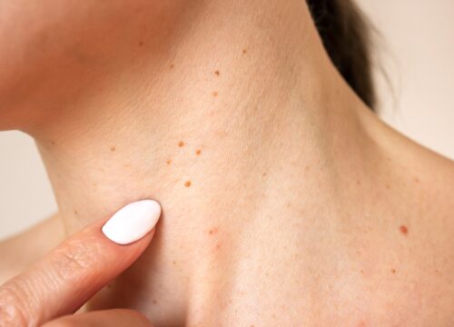 When Should You Worry About a Skin Growth?