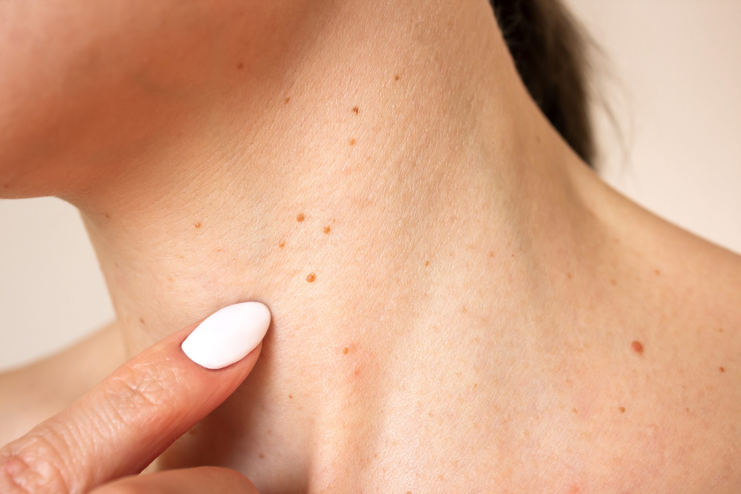 When Should You Worry About a Skin Growth?